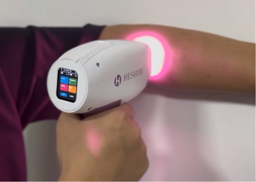 laser hair removal treatment